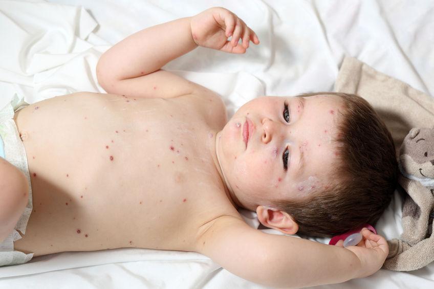 Varicella Rimedi Per Alleviare Il Prurito